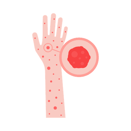 Крапивница