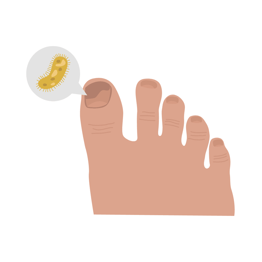 Грибок ногтей (онихомикоз) и стоп (эпидермофитоз стоп)