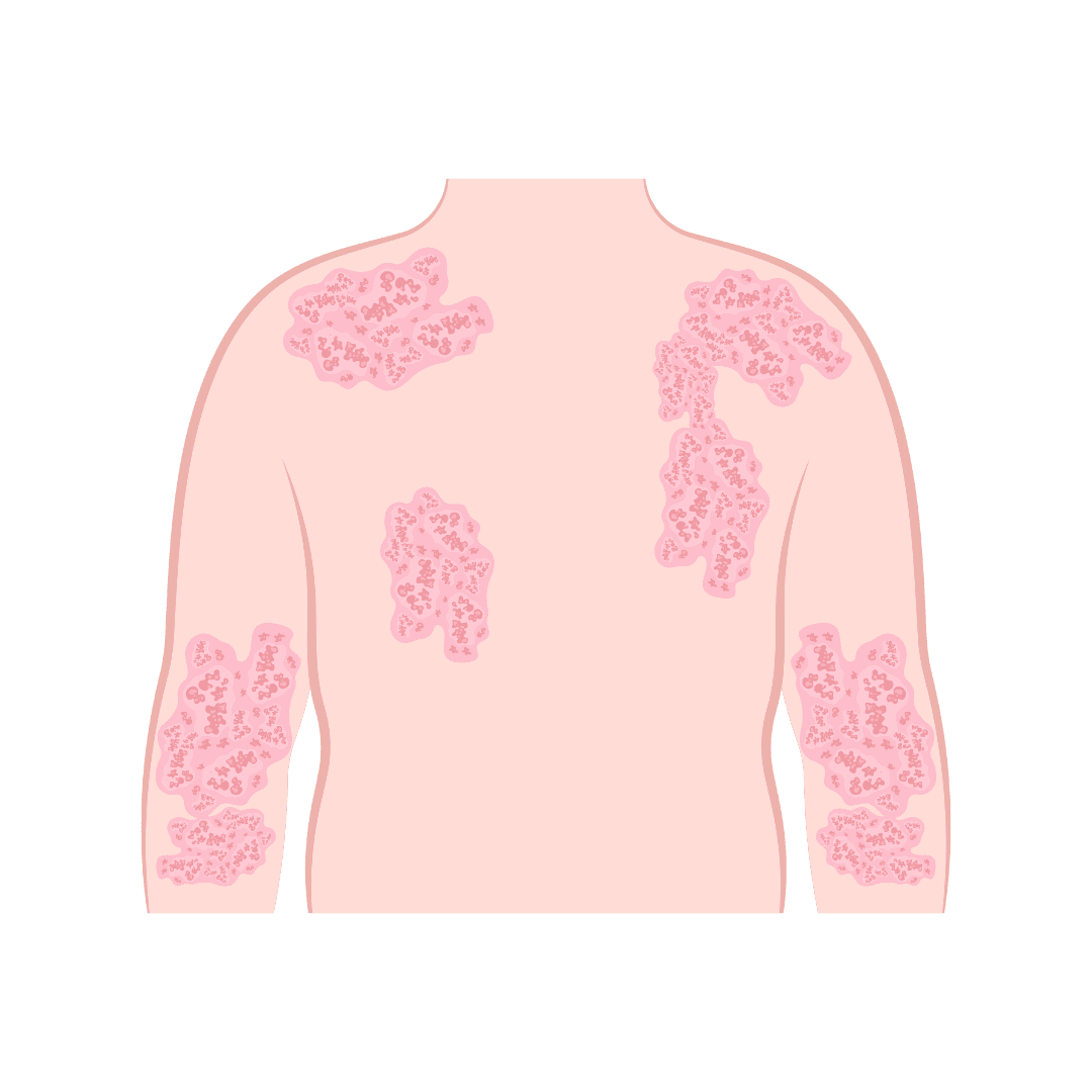 Атопический дерматит, нейродермит