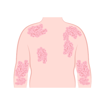 Атопический дерматит, нейродермит