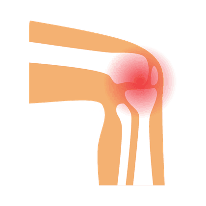 Ревматоидный артрит 