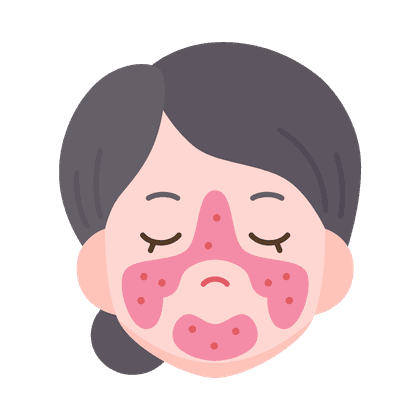 Купероз (сосудистые звёздочки)