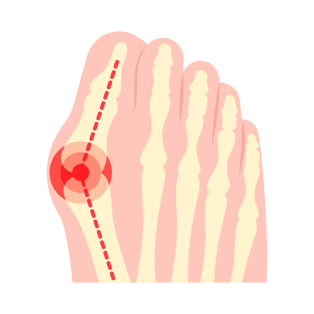 Вальгусная деформация (косточка на стопе)
